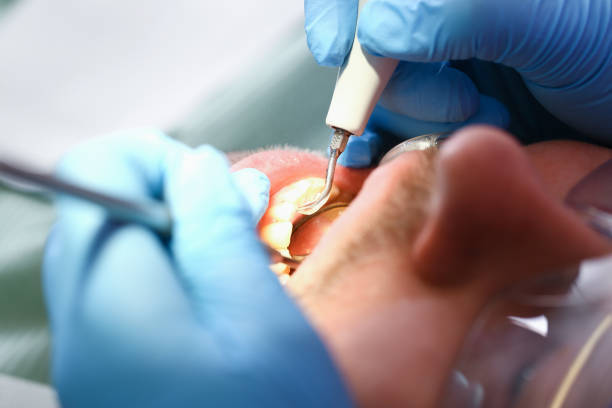 Best Emergency Dentist for Lost Fillings or Crowns in Lochmoor Waterway Estates, FL